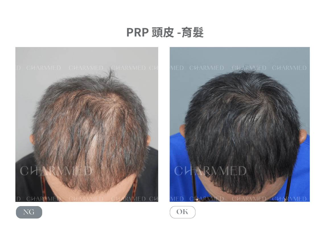 PRP - 頭皮育髮 - 吳明憲醫師案例