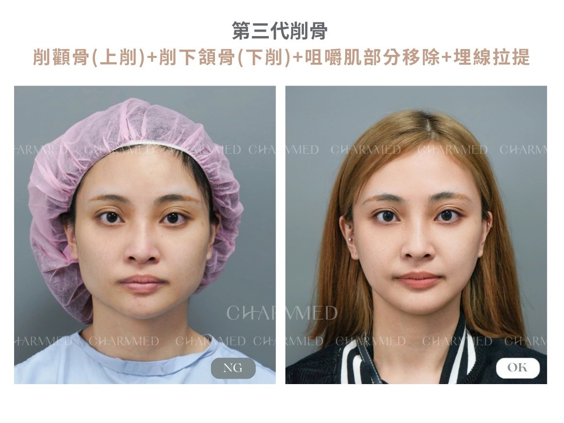 第三代削骨真實案例