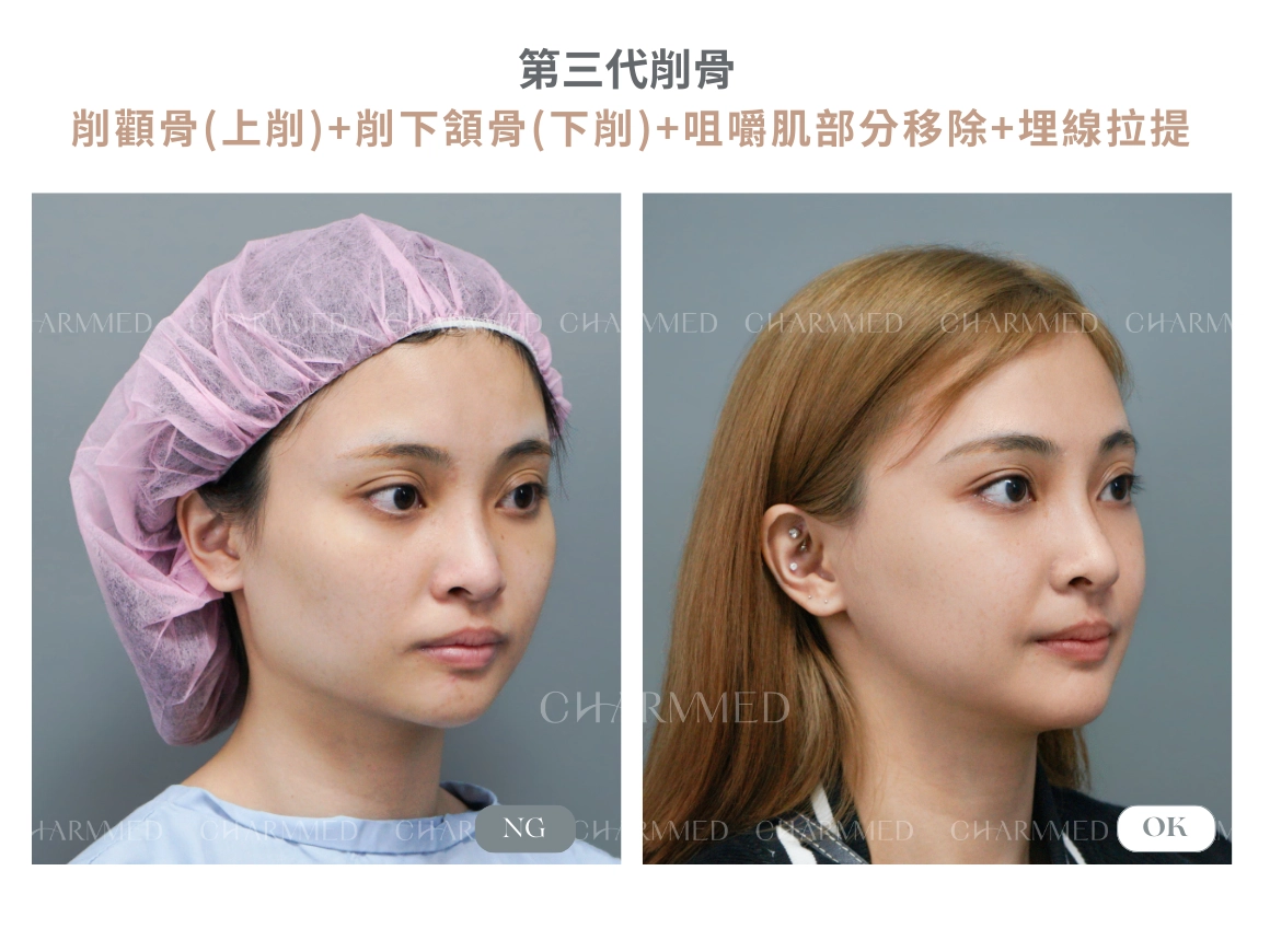 第三代削骨真實案例