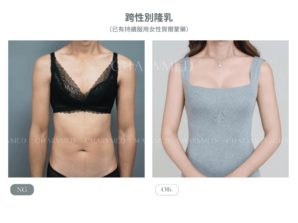 内視鏡隆乳(珍珠波)