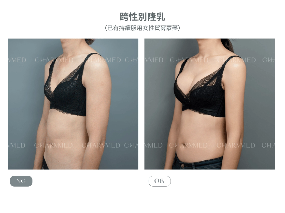 内視鏡隆乳(珍珠波)