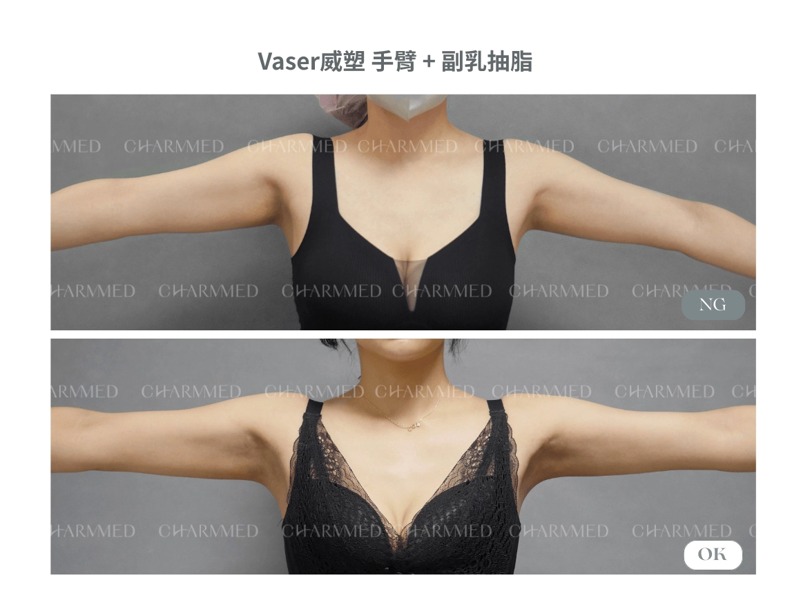 威塑Vaser - 手臂、副乳抽脂