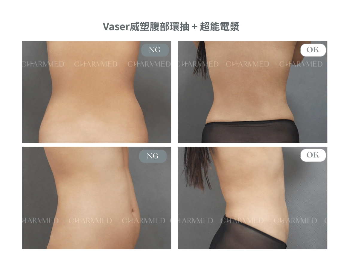 威塑Vaser - 腹部抽脂+超能電漿