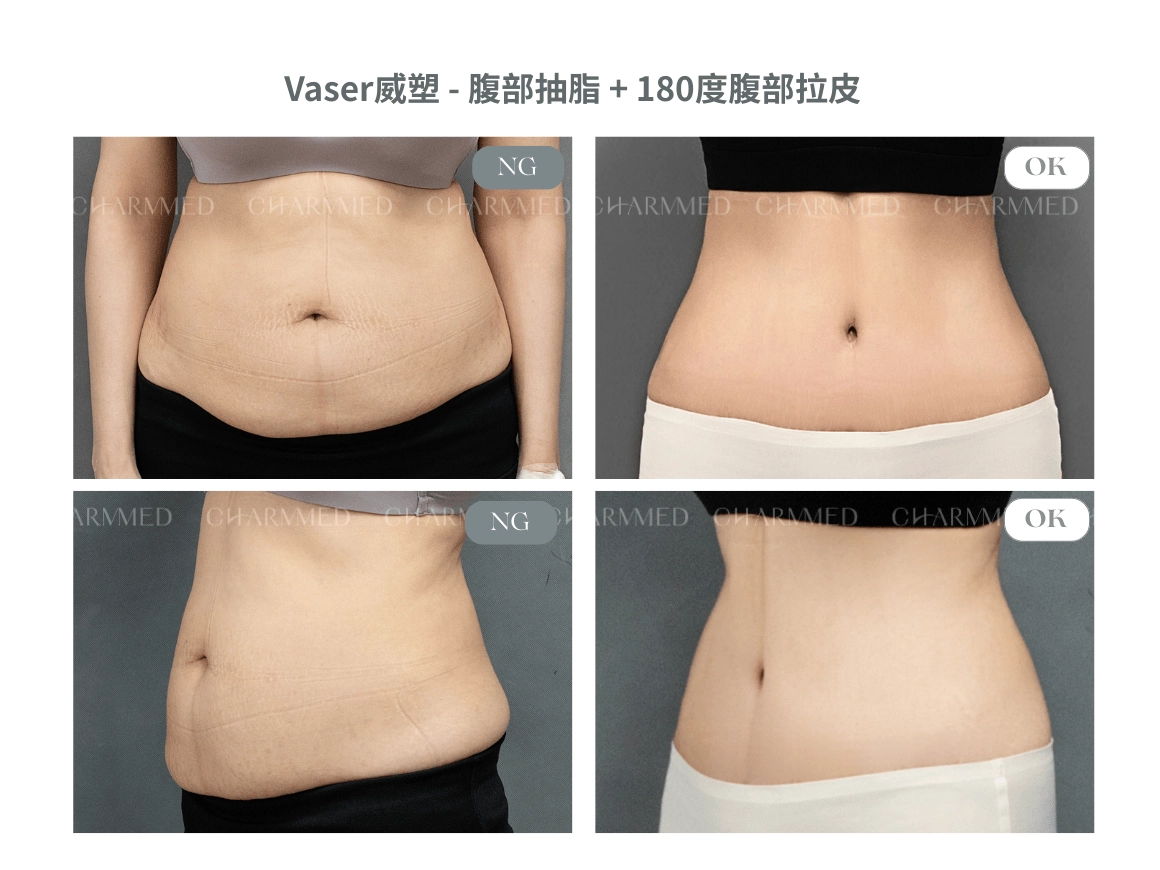 資深整形外科吳明憲醫師腹部拉皮案例