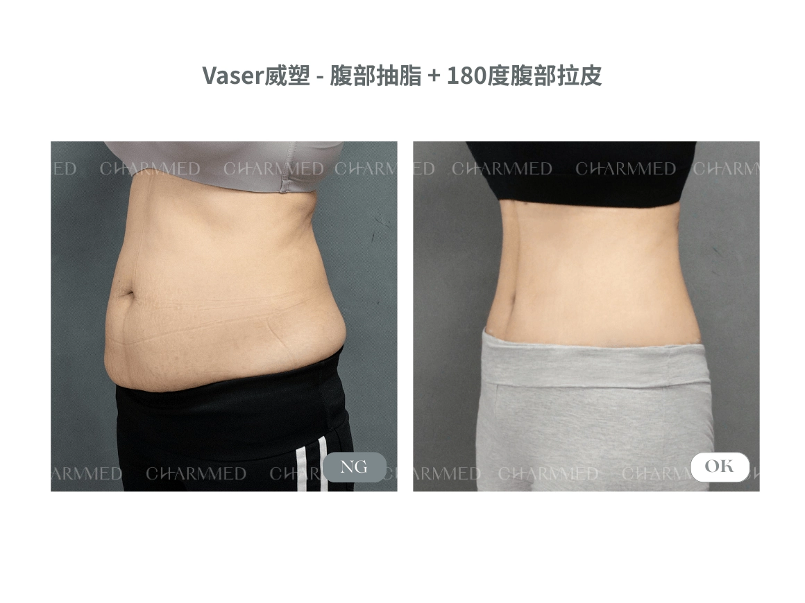 資深整形外科吳明憲醫師腹部拉皮案例