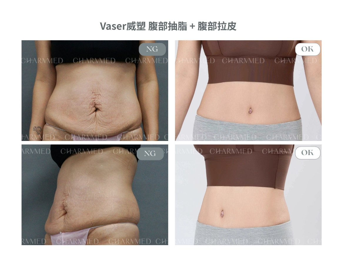 資深整形外科林孟羲醫師腹部拉皮案例