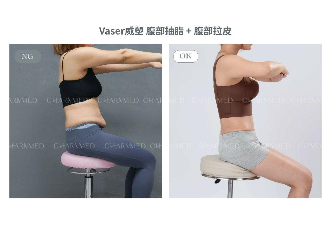 資深整形外科林孟羲醫師腹部拉皮案例