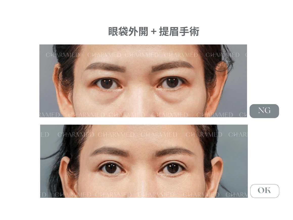 提眉手術(眉上切 / 眉下切)