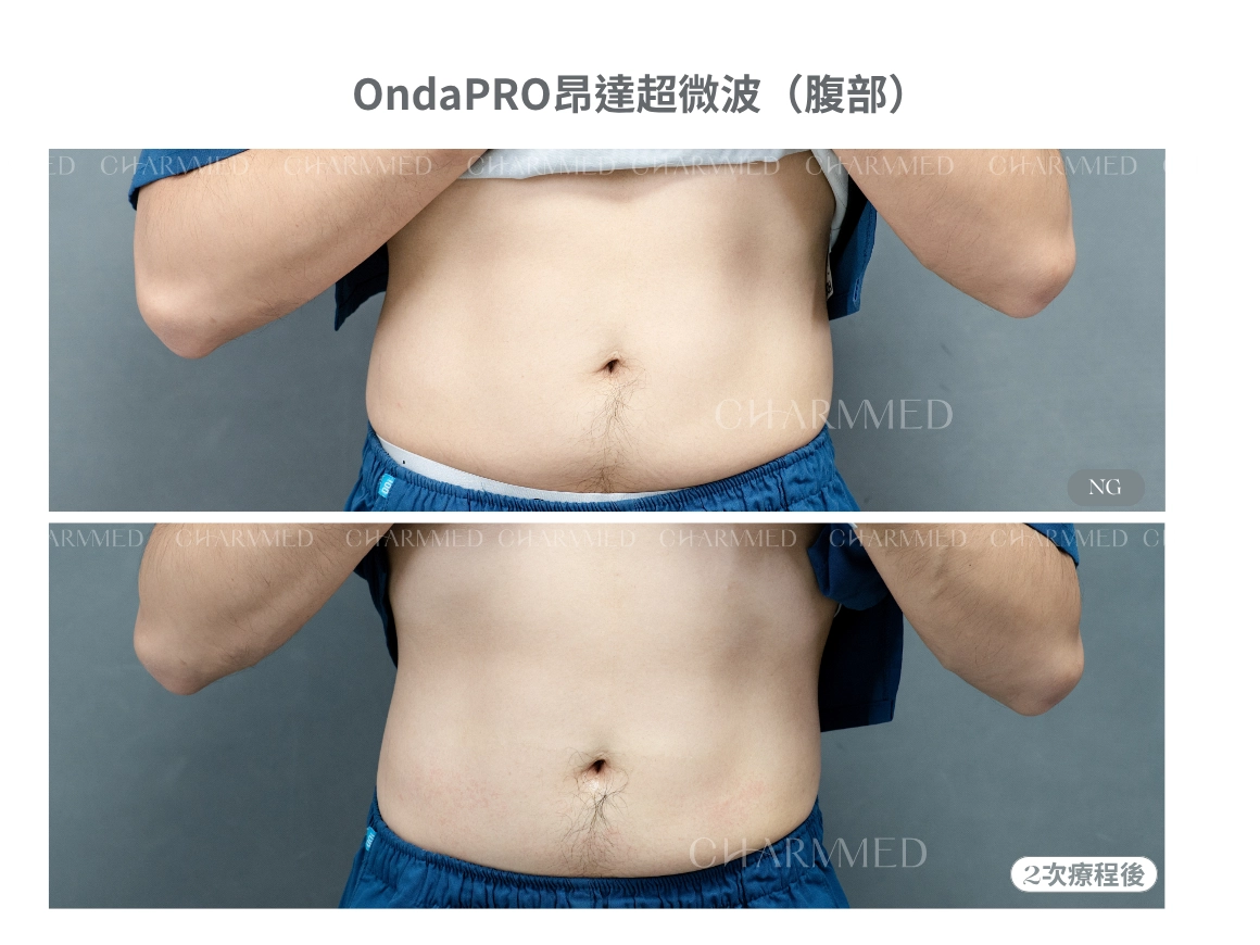 OndaPRO超微波(腰腹部)