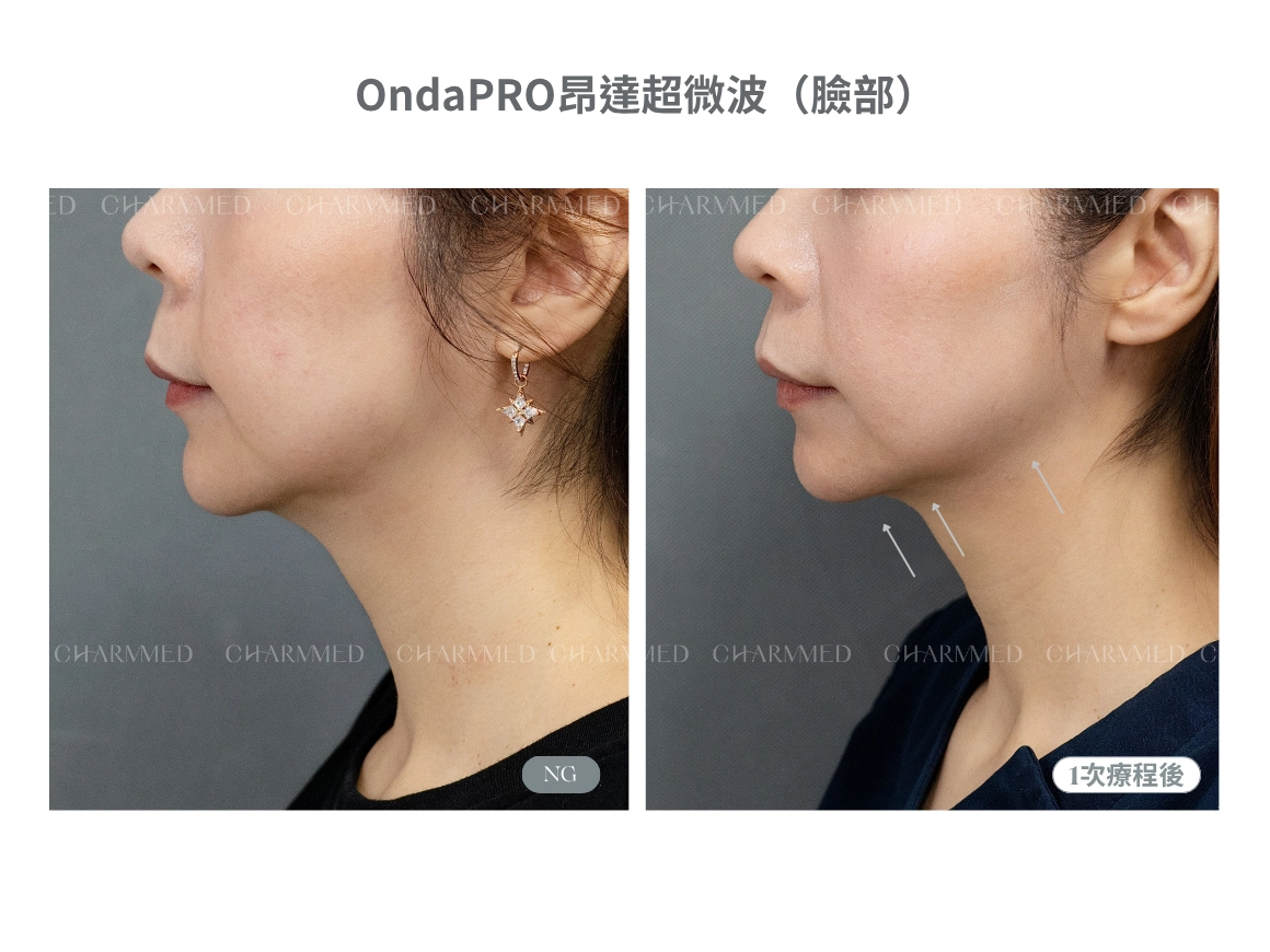 OndaPRO超微波(臉頸部)