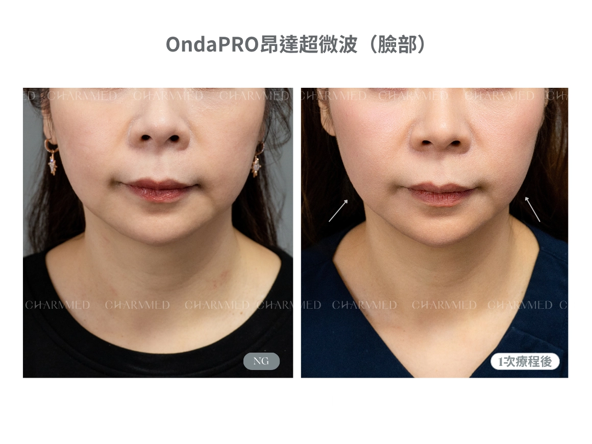 OndaPRO超微波(臉頸部)