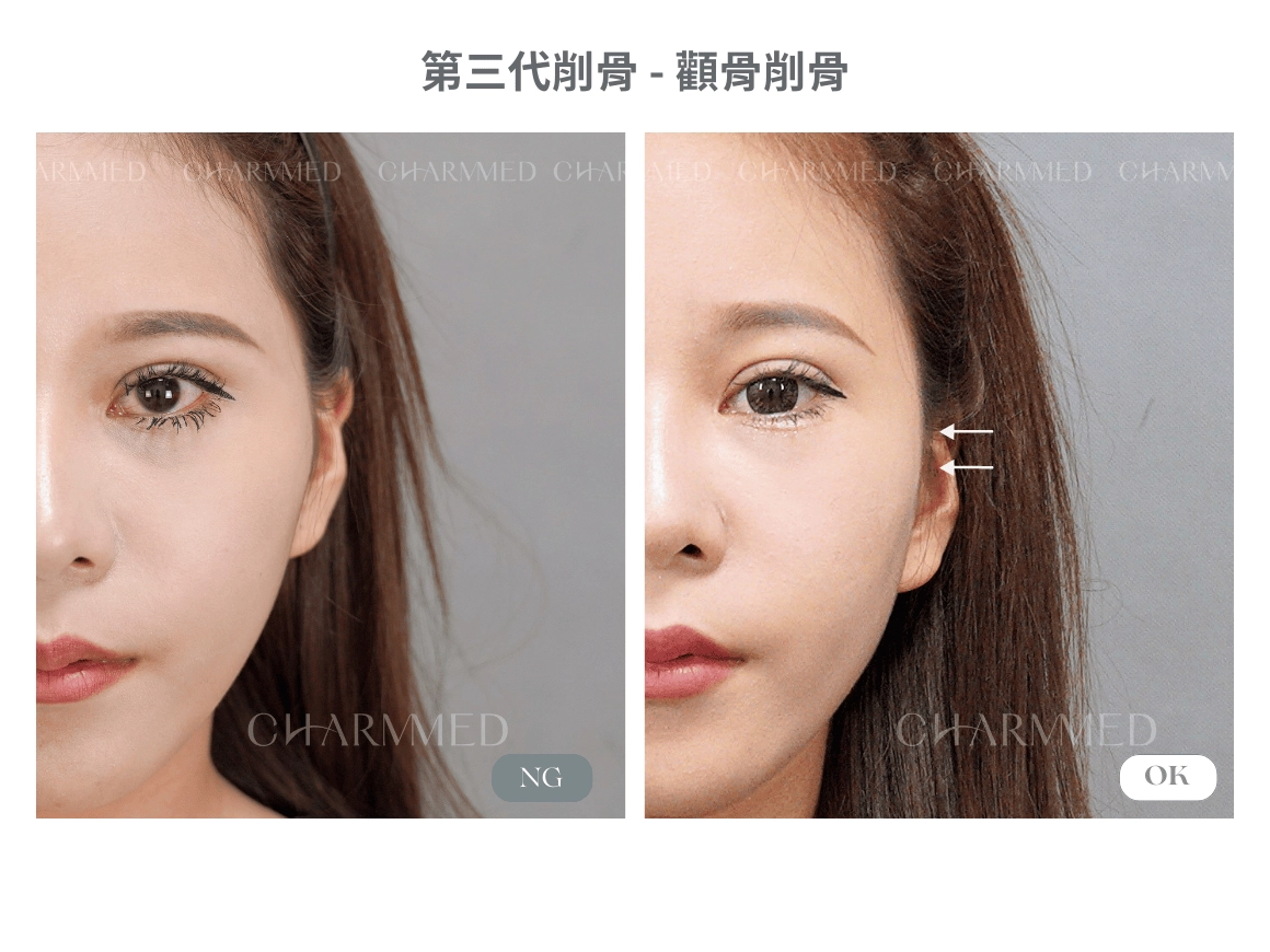 第三代削骨 真實案例