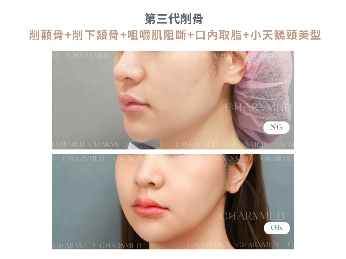 第三代削骨 真實案例