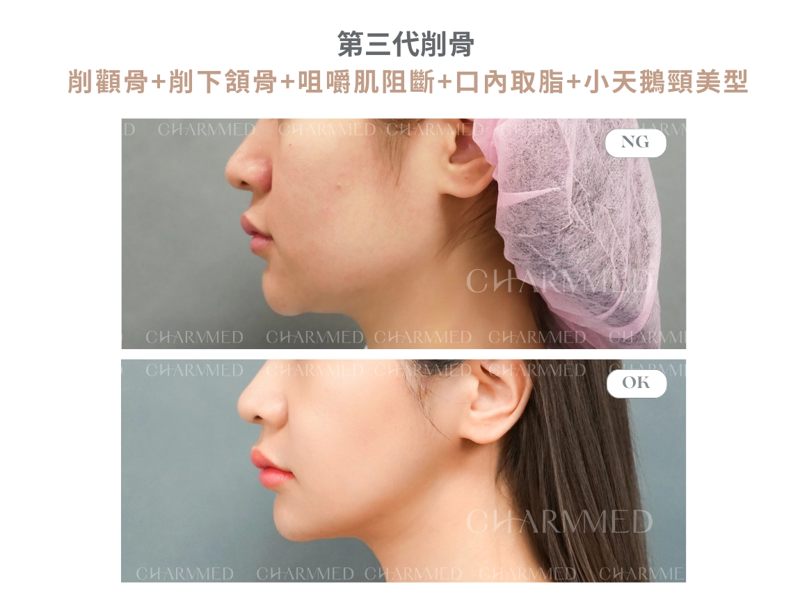 第三代削骨 真實案例