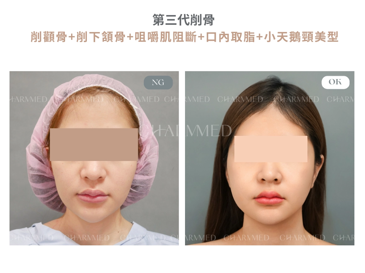 第三代削骨 真實案例