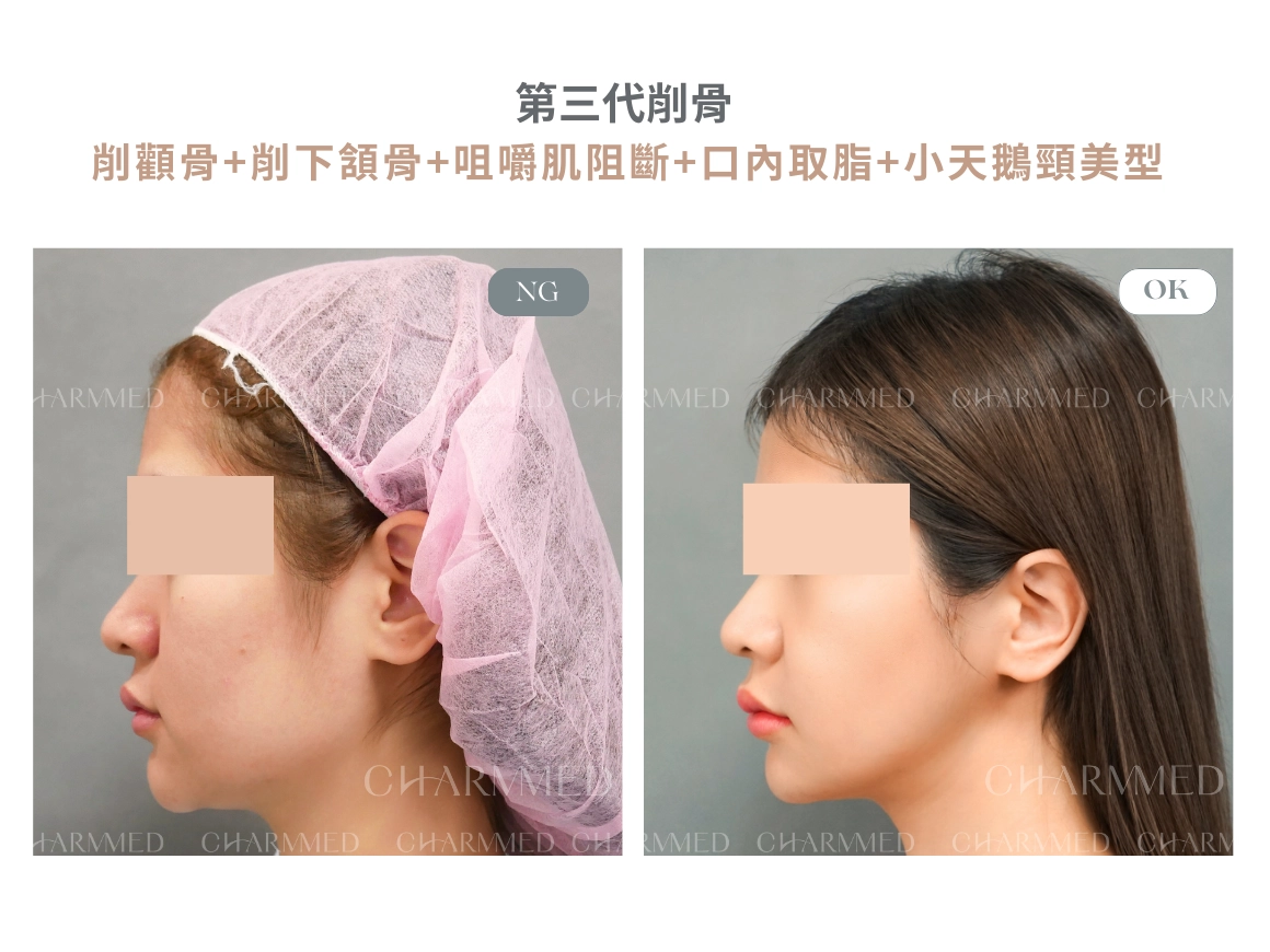 第三代削骨 真實案例