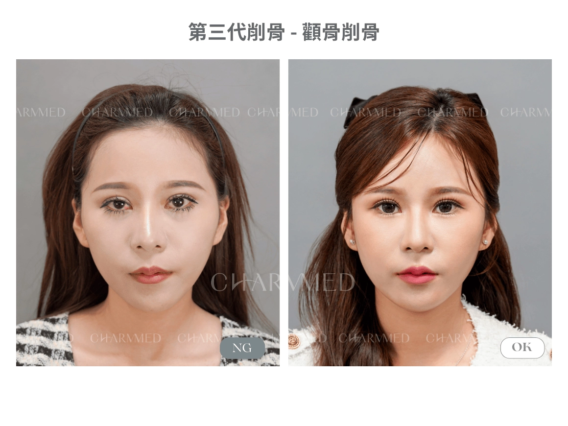 第三代削骨 真實案例