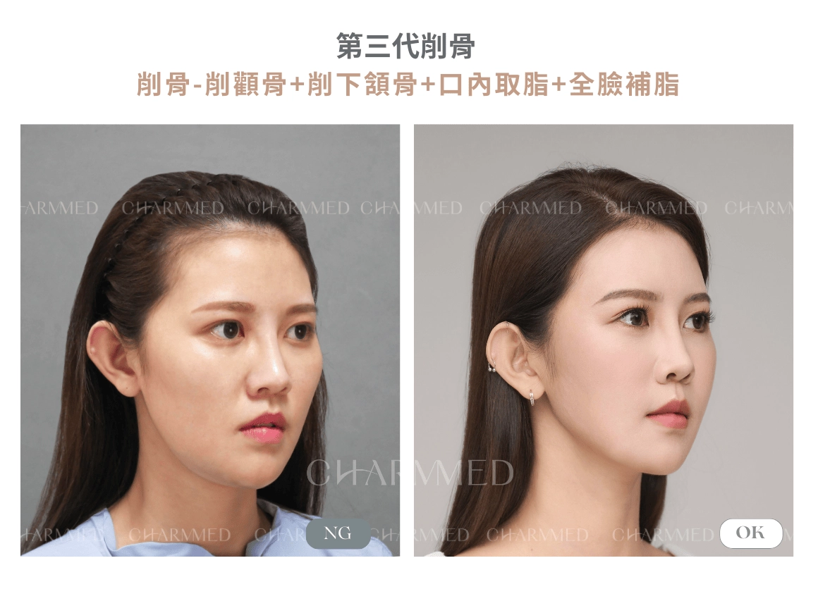 第三代削骨 真實案例