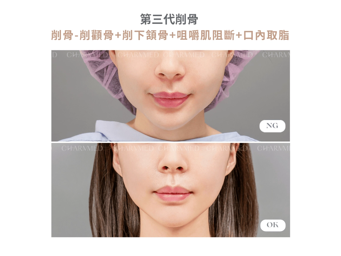 第三代削骨 真實案例