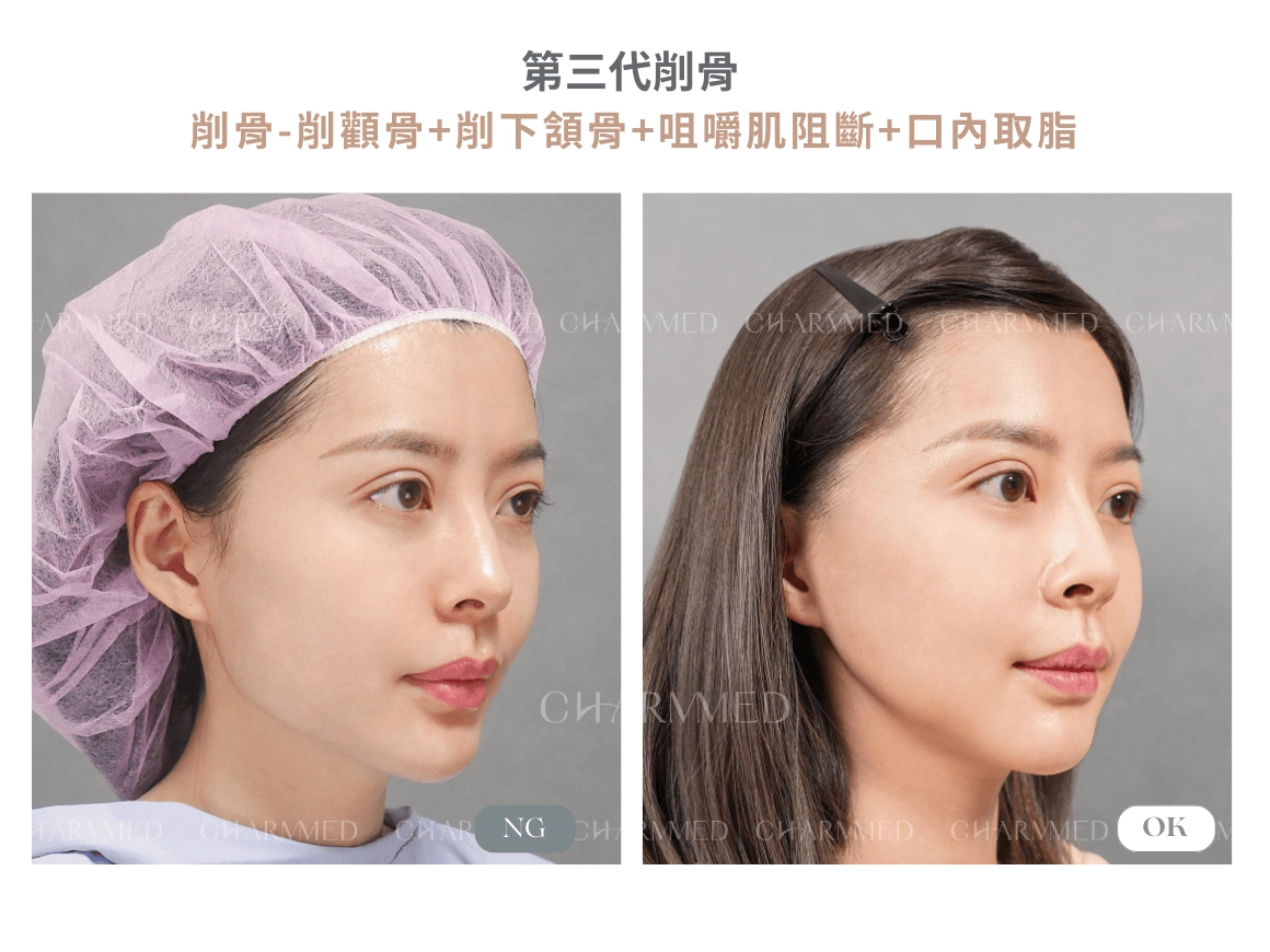 第三代削骨 真實案例