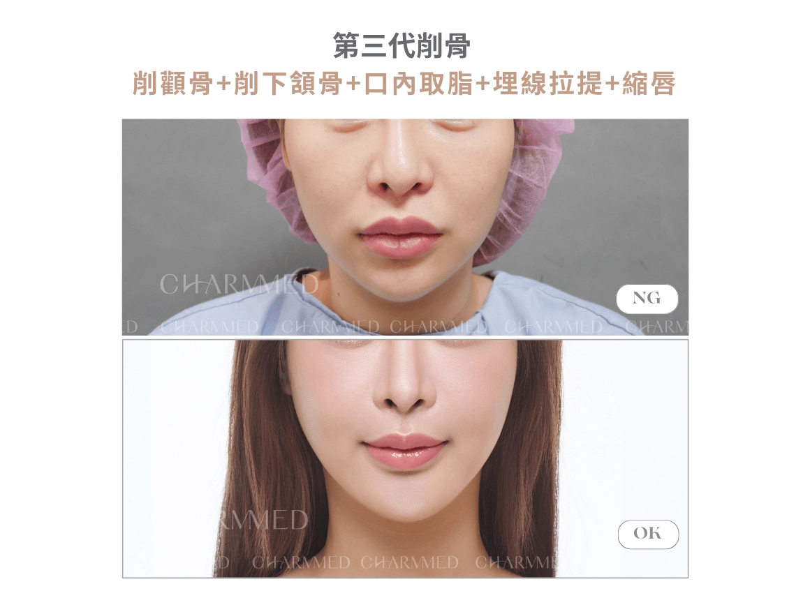 第三代削骨 真實案例