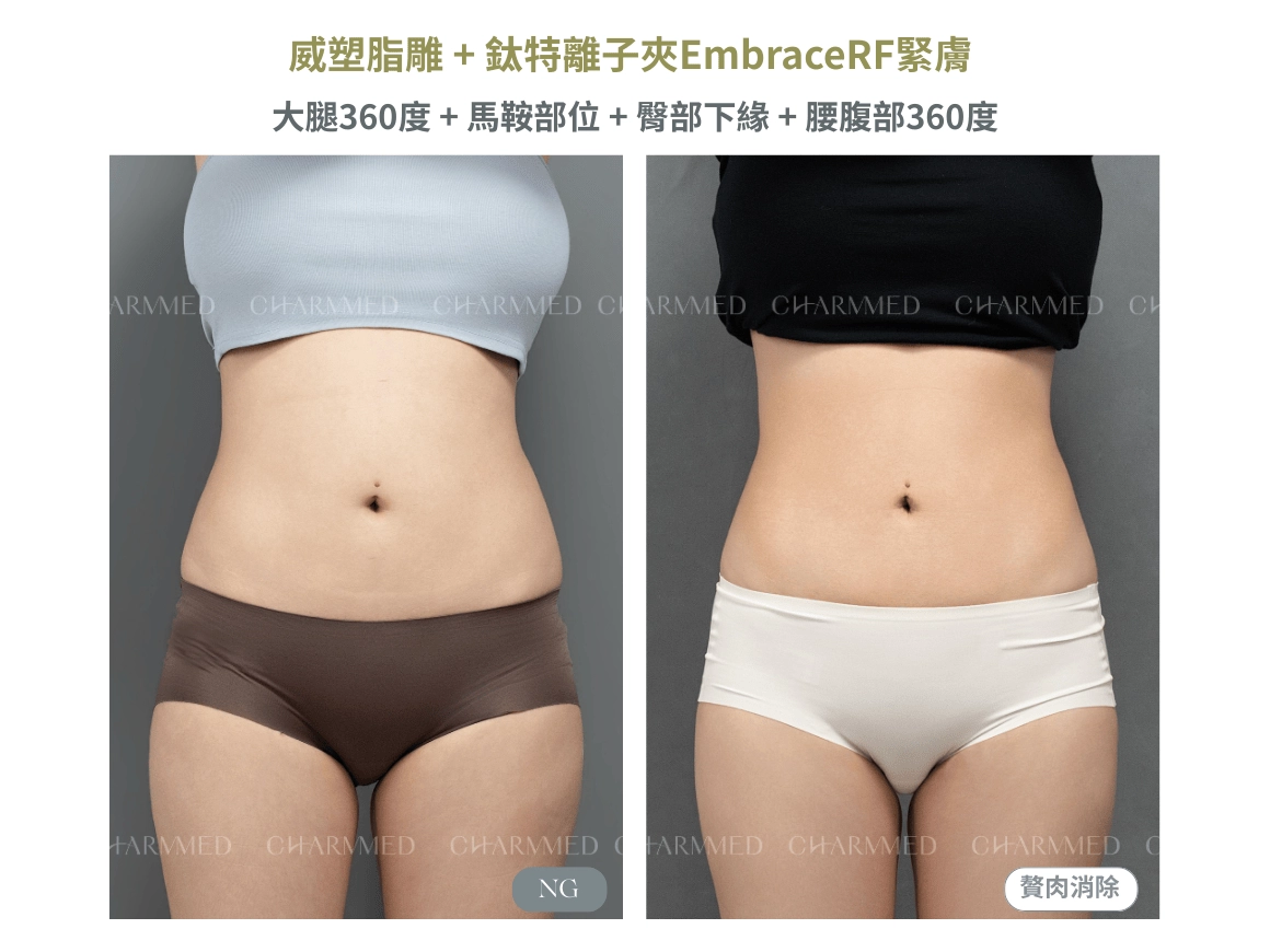 威塑Vaser抽脂+鈦特離子夾EmbraceRF-bodytight緊膚