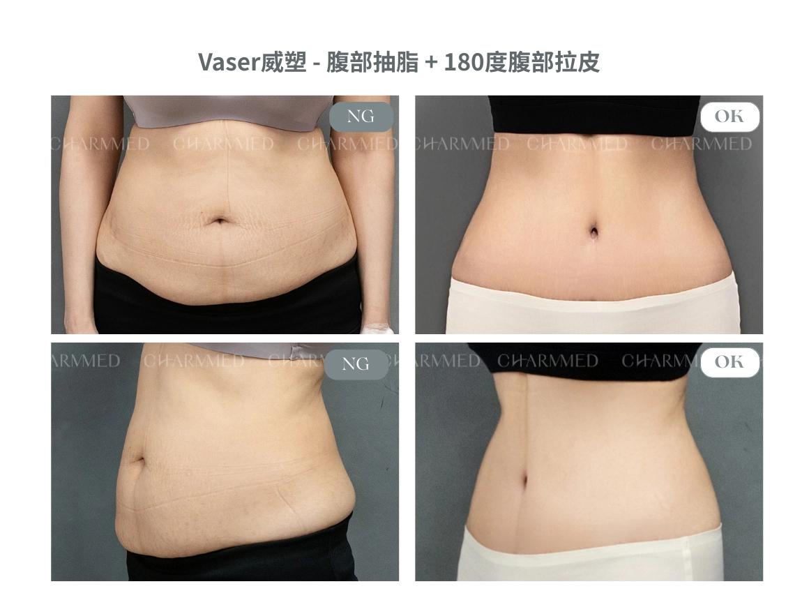 Vaser威塑抽脂-腹部環抽+腹部拉皮