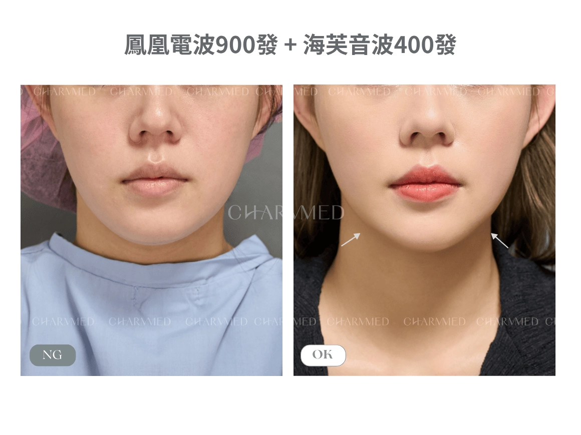 電音波雙打療程