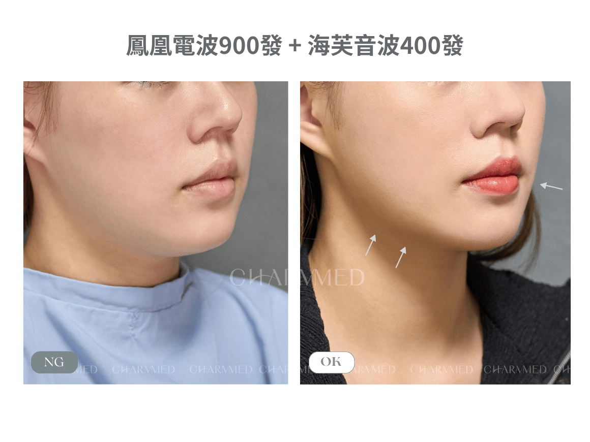 電音波雙打療程