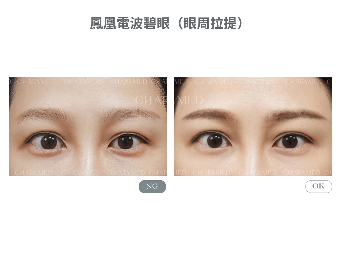 鳳凰電波碧眼(眼周拉提)