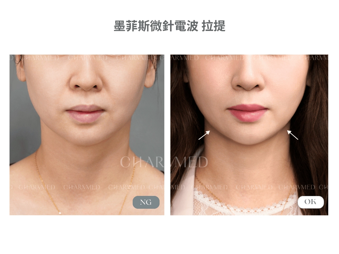 墨菲斯微針電波