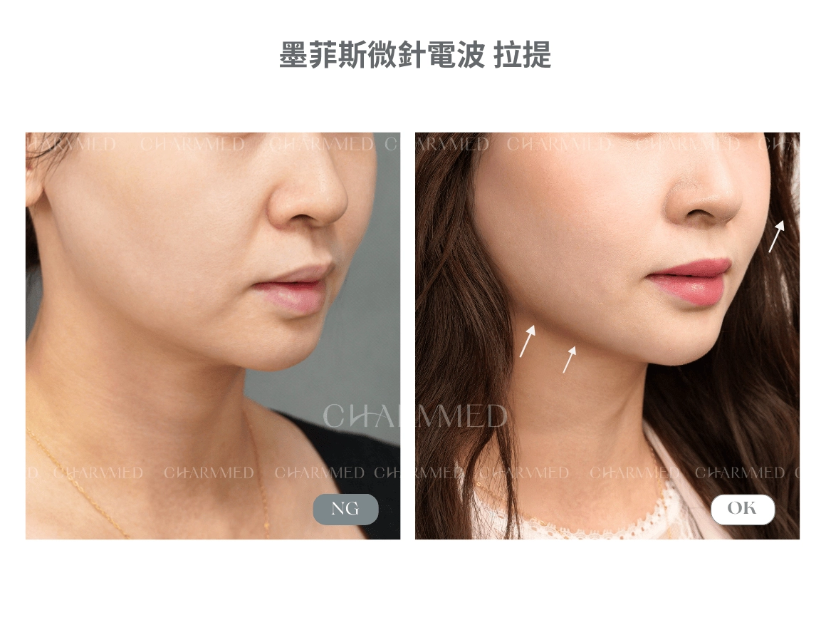 墨菲斯微針電波