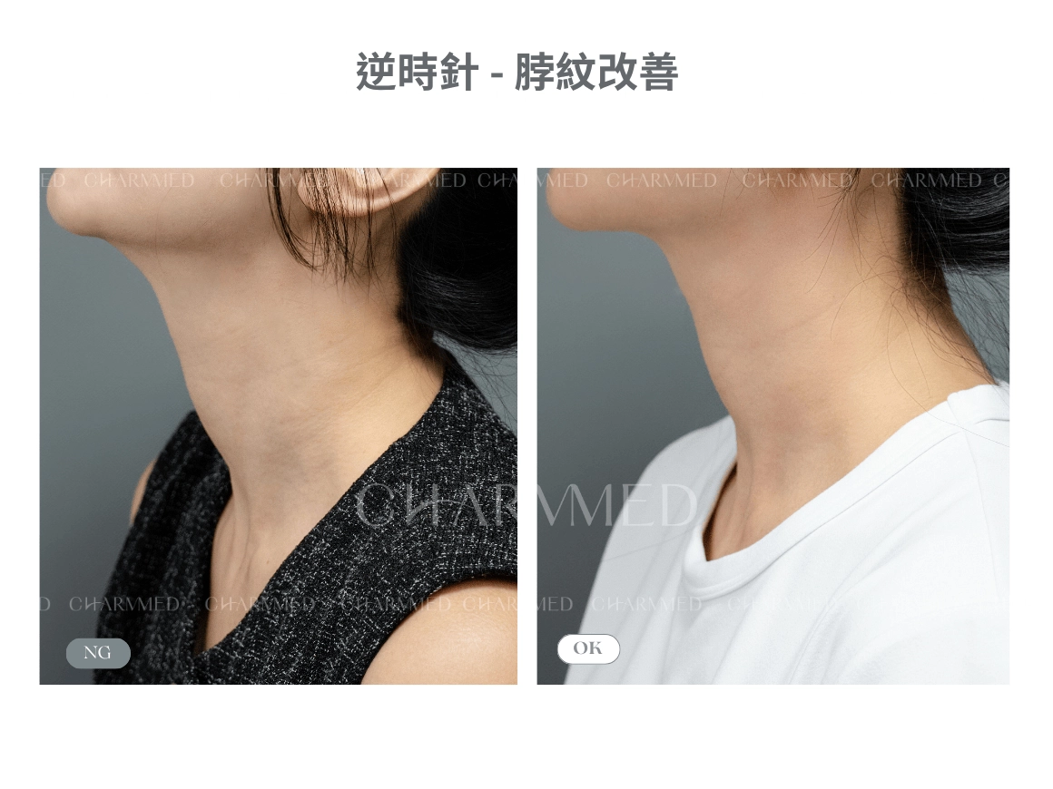 逆時針-頸部紋路改善