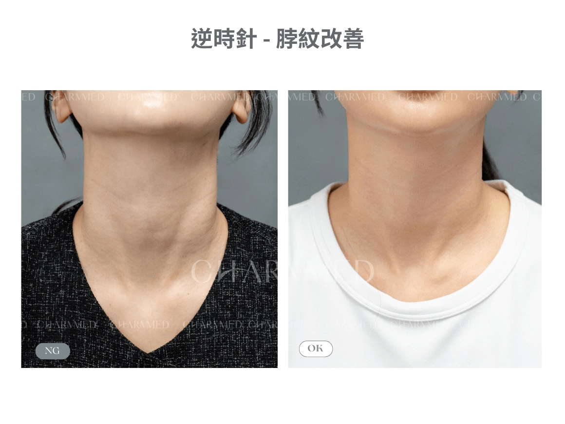 逆時針-頸部紋路改善