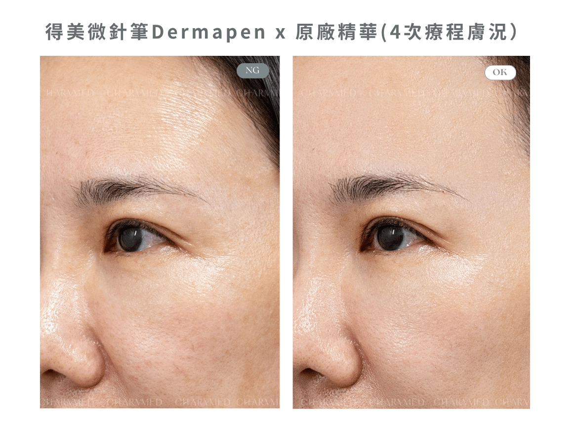 Dermapen 德美微針筆