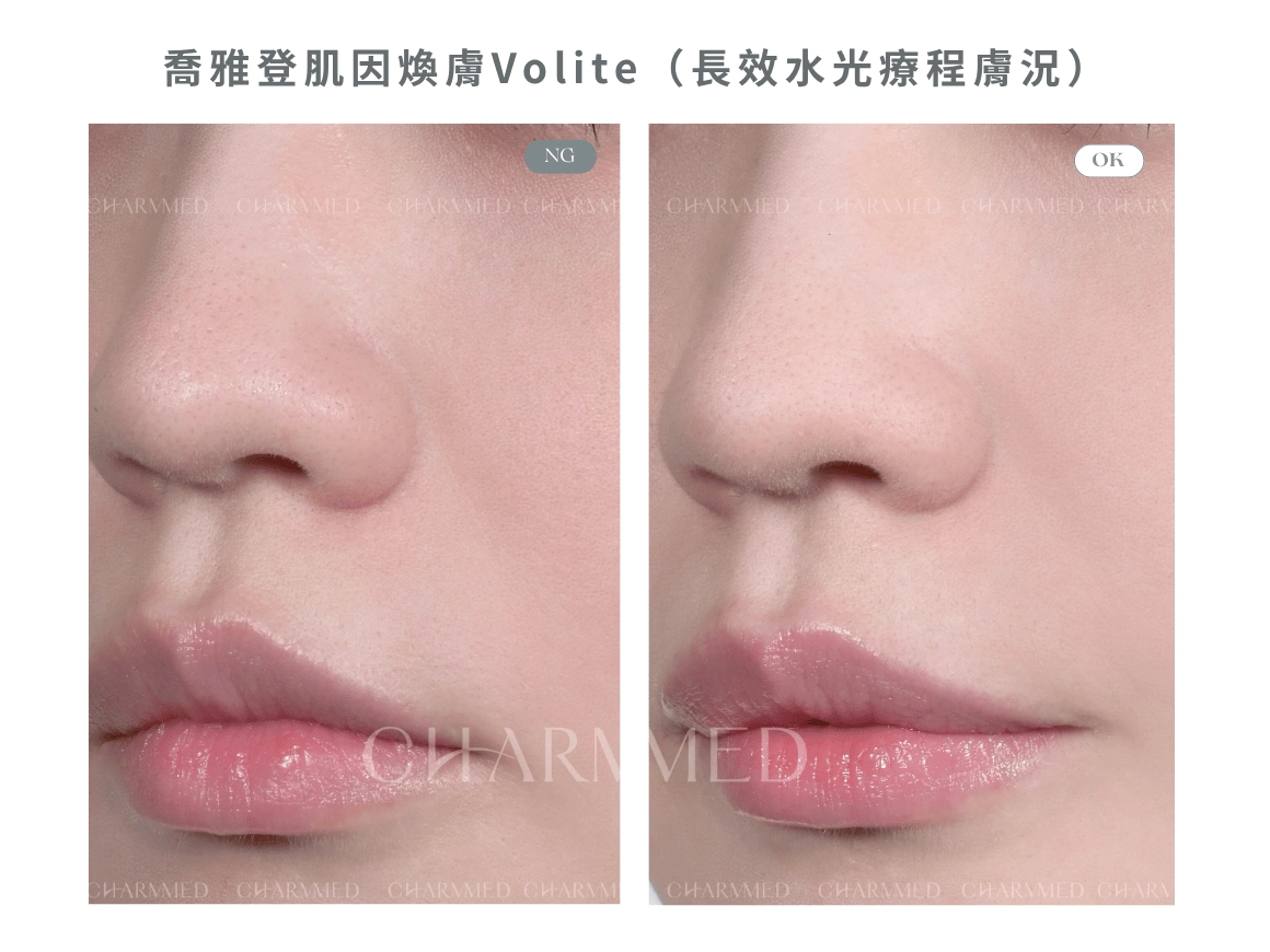 喬雅登肌因煥膚Volite(長效水光療程膚況)