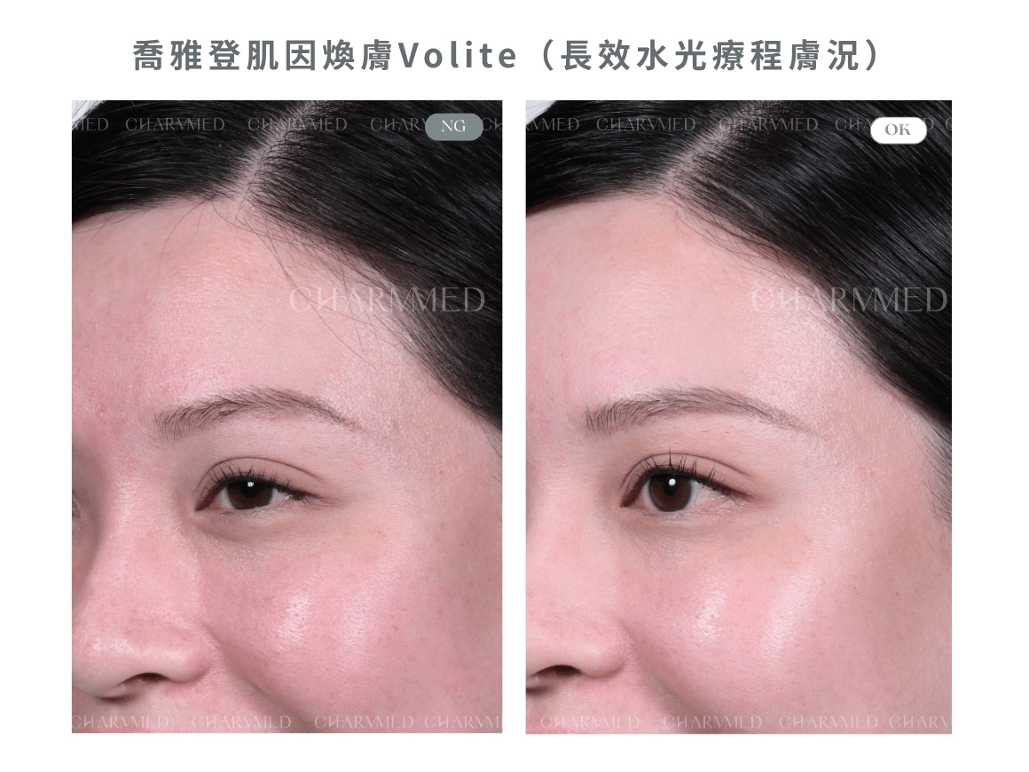 喬雅登肌因煥膚Volite(長效水光療程膚況)