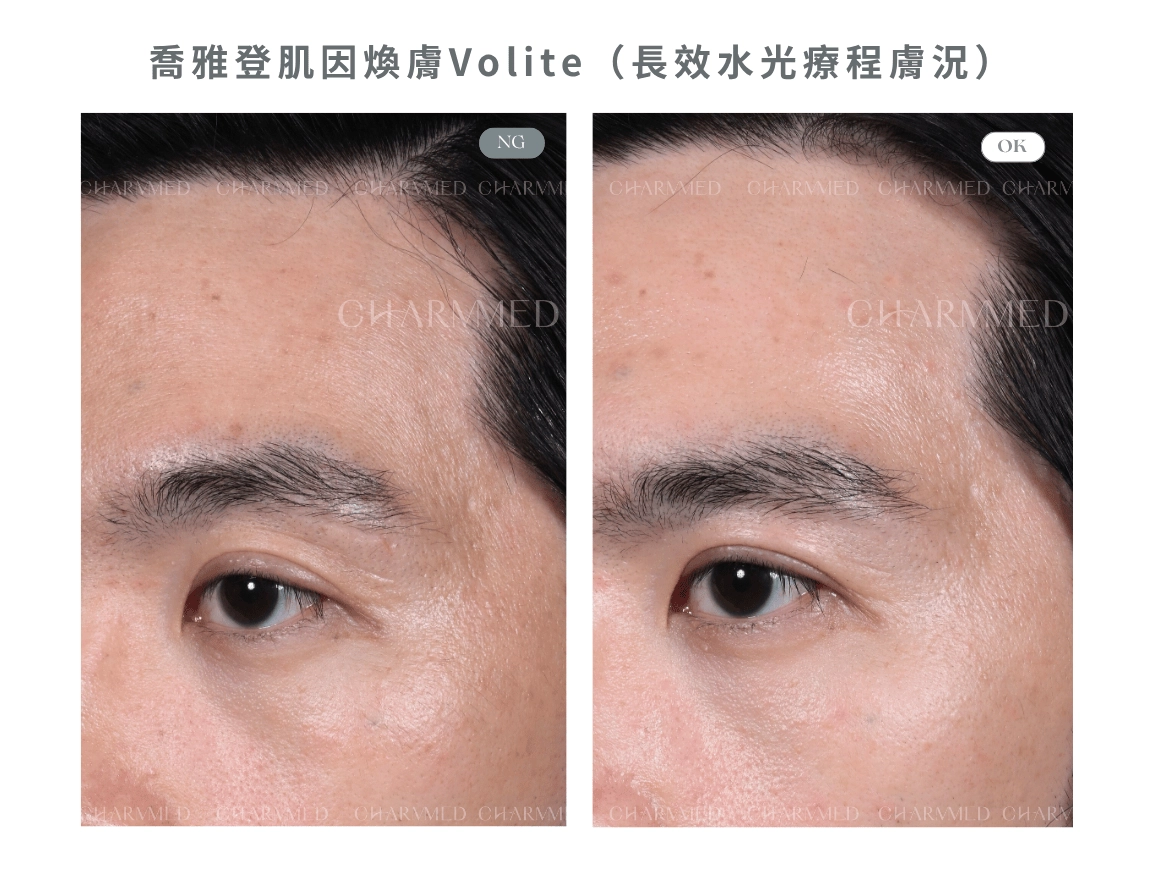 喬雅登肌因煥膚Volite(長效水光療程膚況)