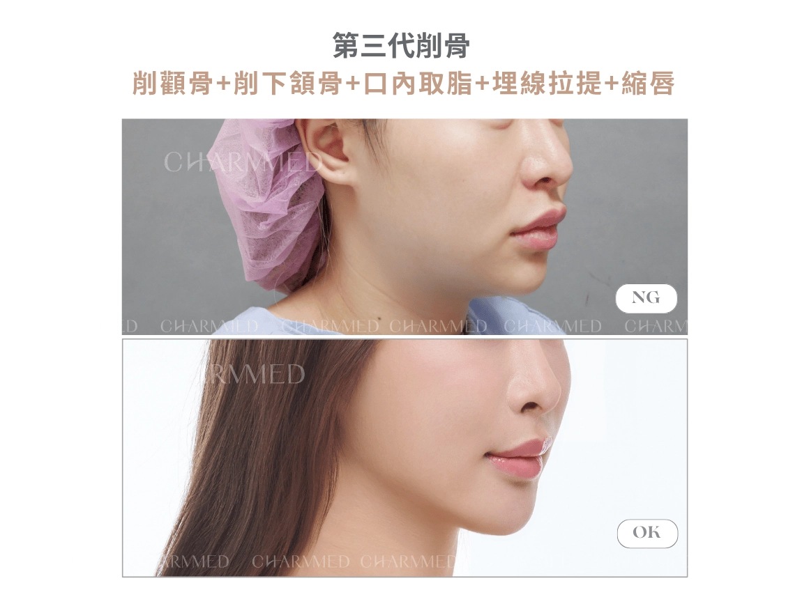 第三代削骨 - 整形外科林孟羲醫師