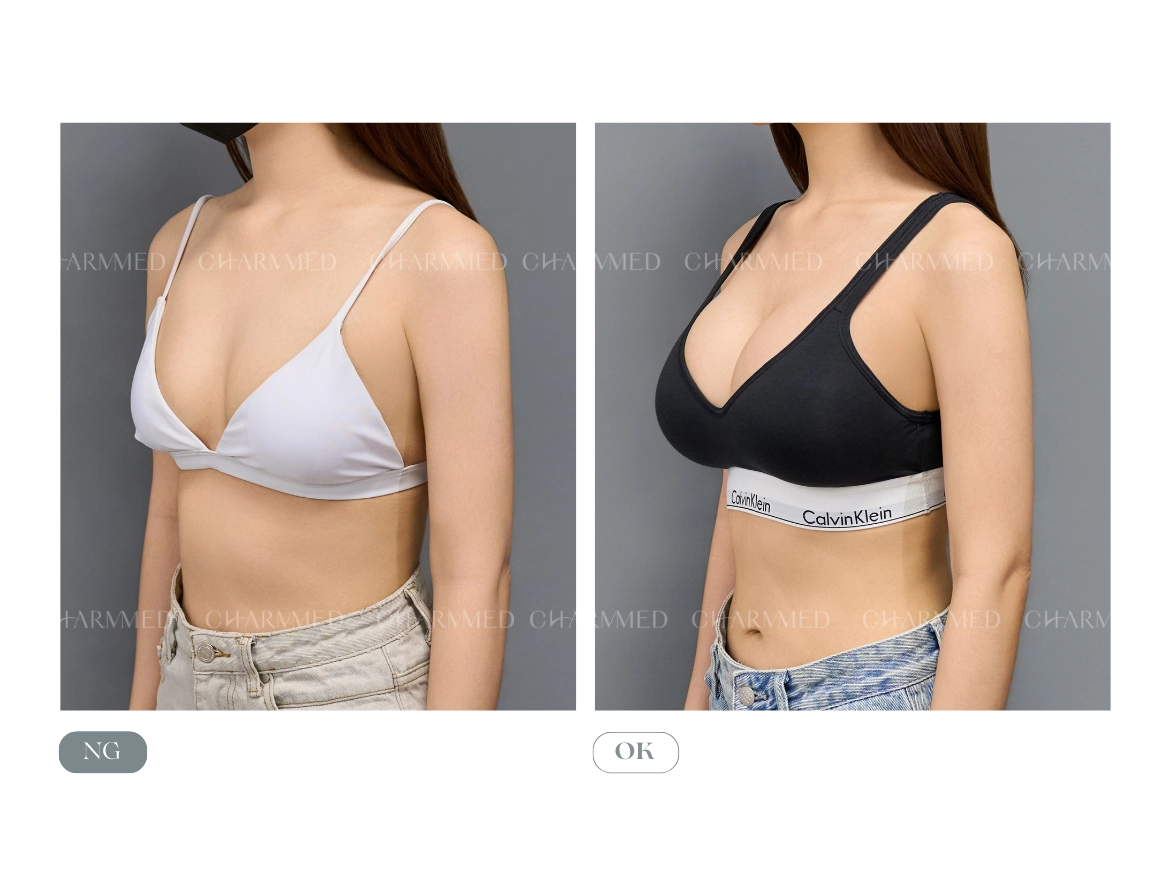 珍珠波-林孟羲醫師隆乳案例