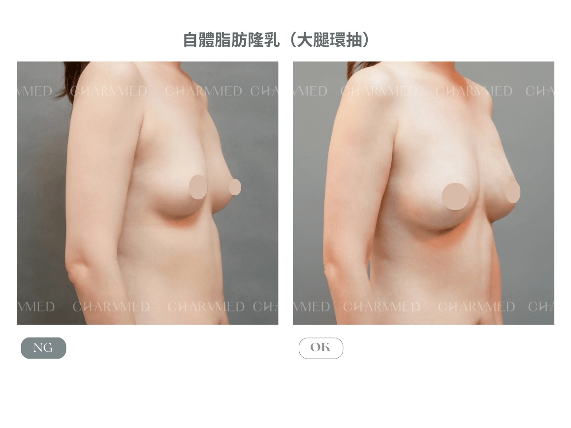 自體脂肪隆乳案例