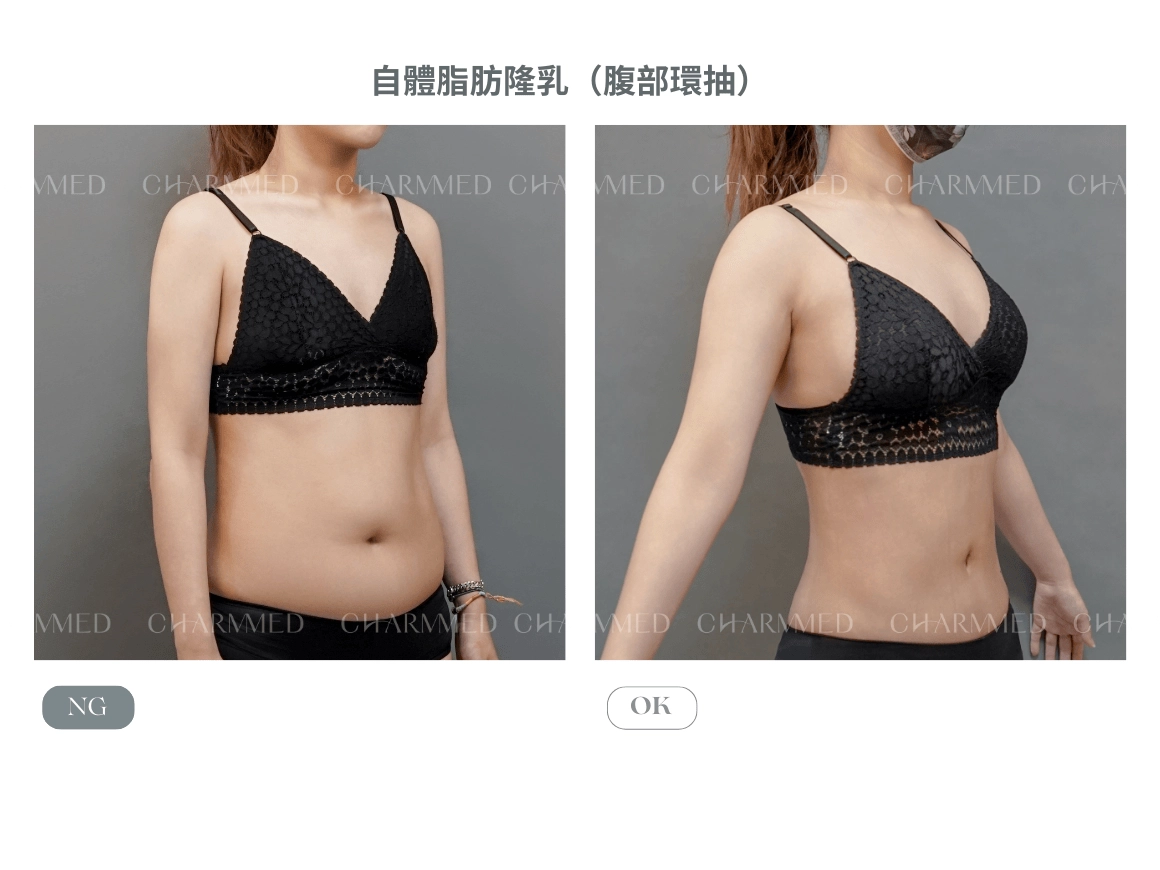 自體脂肪隆乳案例-林孟羲醫師隆乳案例