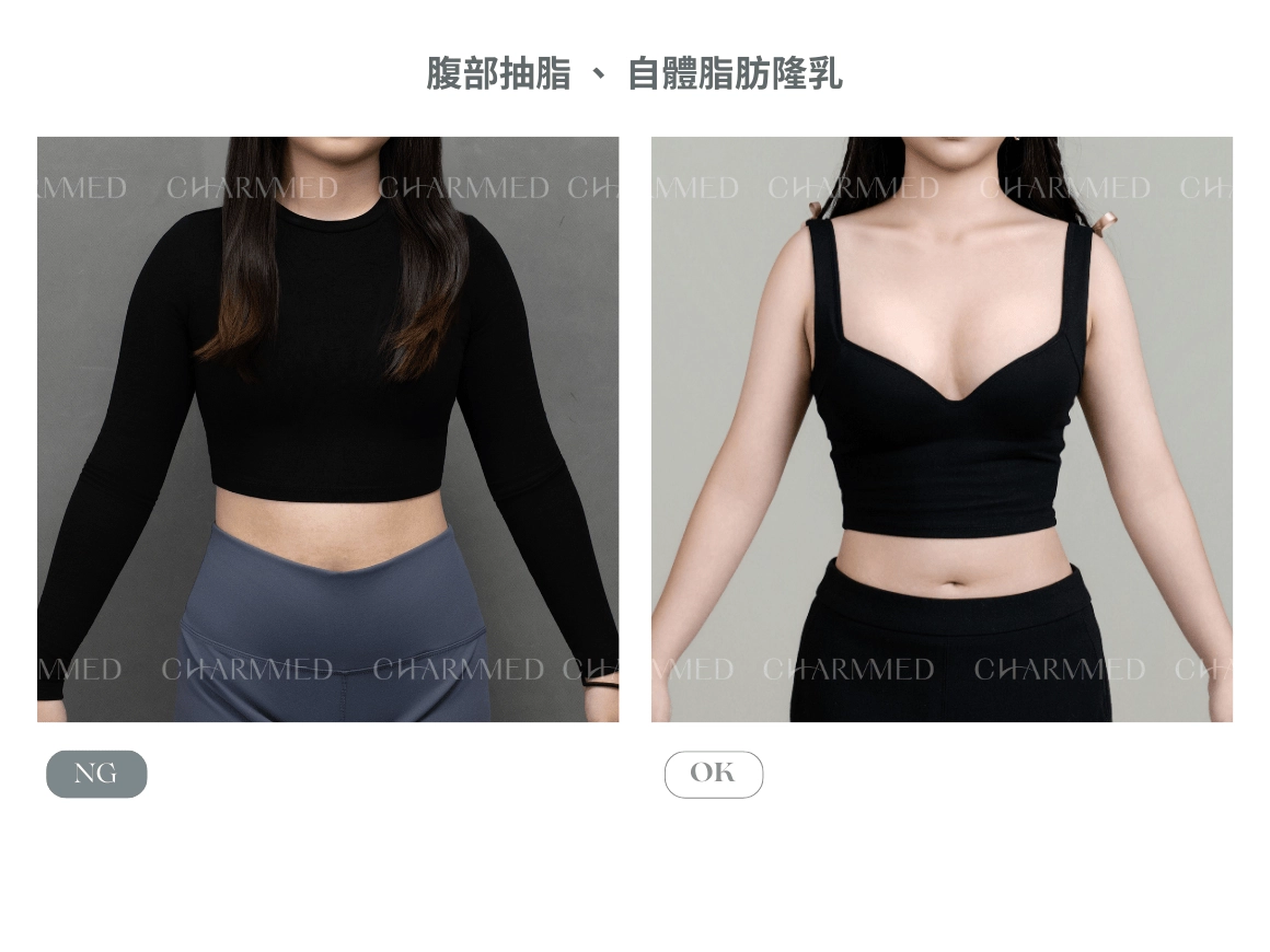 自體脂肪隆乳案例-陳耕醫師隆乳案例
