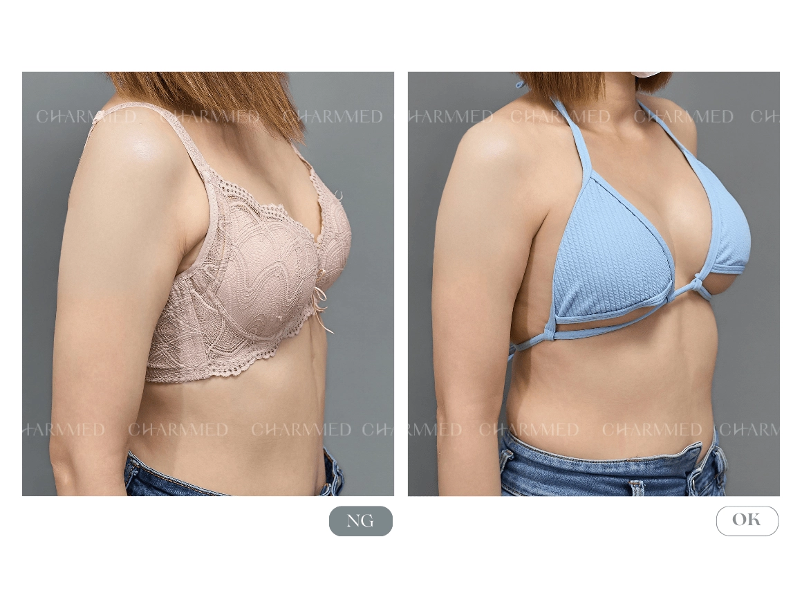 繆思女神波 -蔡青穎醫師隆乳案例