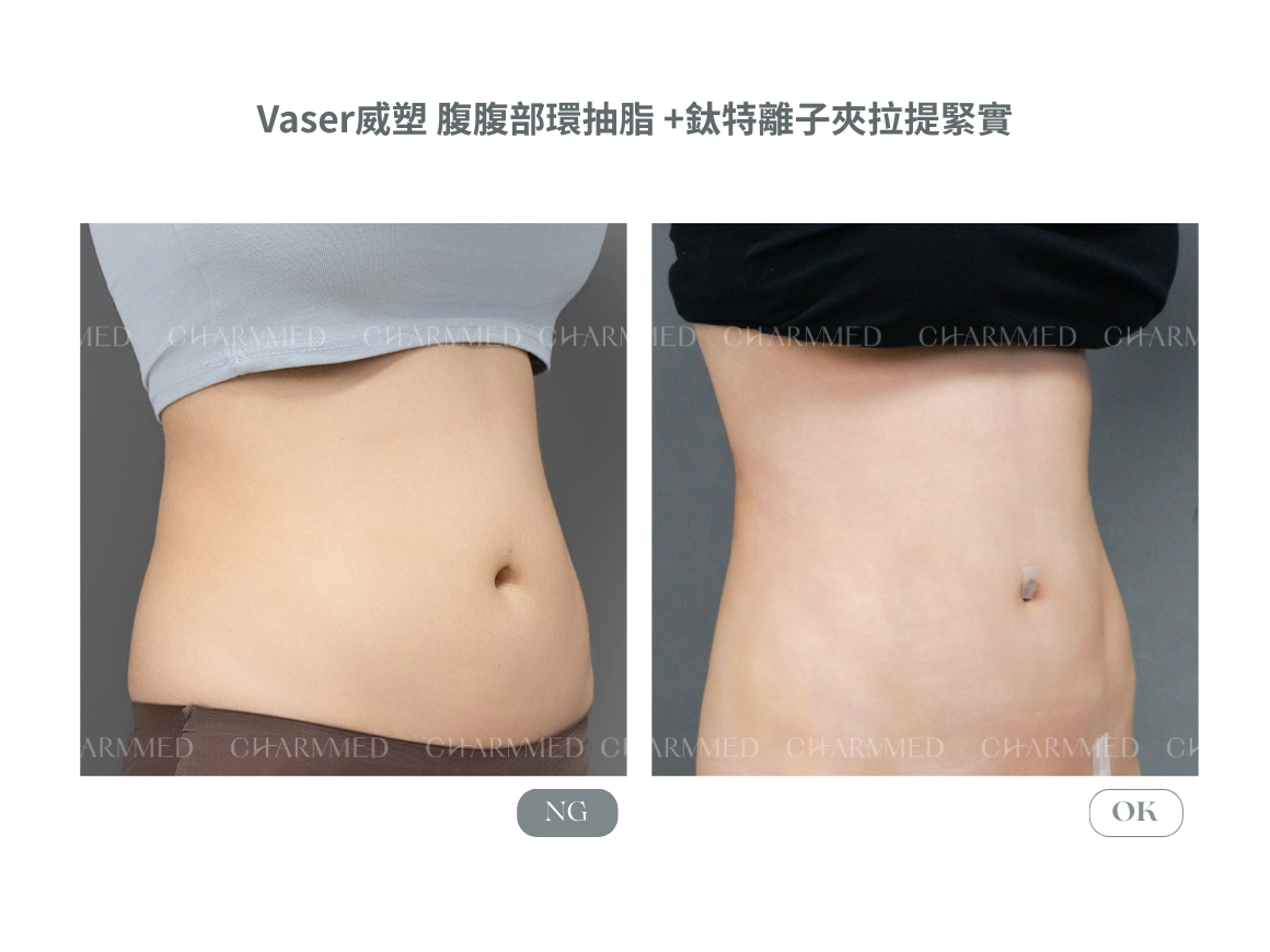 威塑 腰腹抽脂x 鈦特離子夾