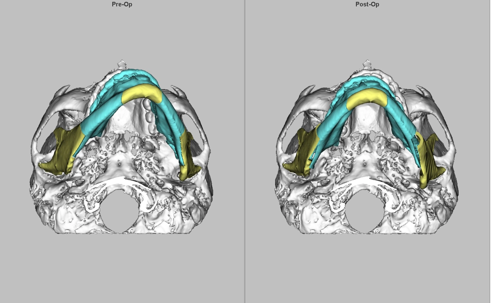 正顎手術模擬圖