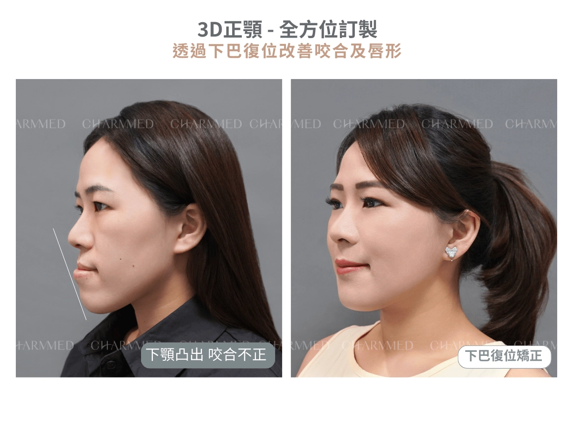 正顎不是只改變臉型!從咬合問題到顳顎關節,陳人瑄醫師完整解析