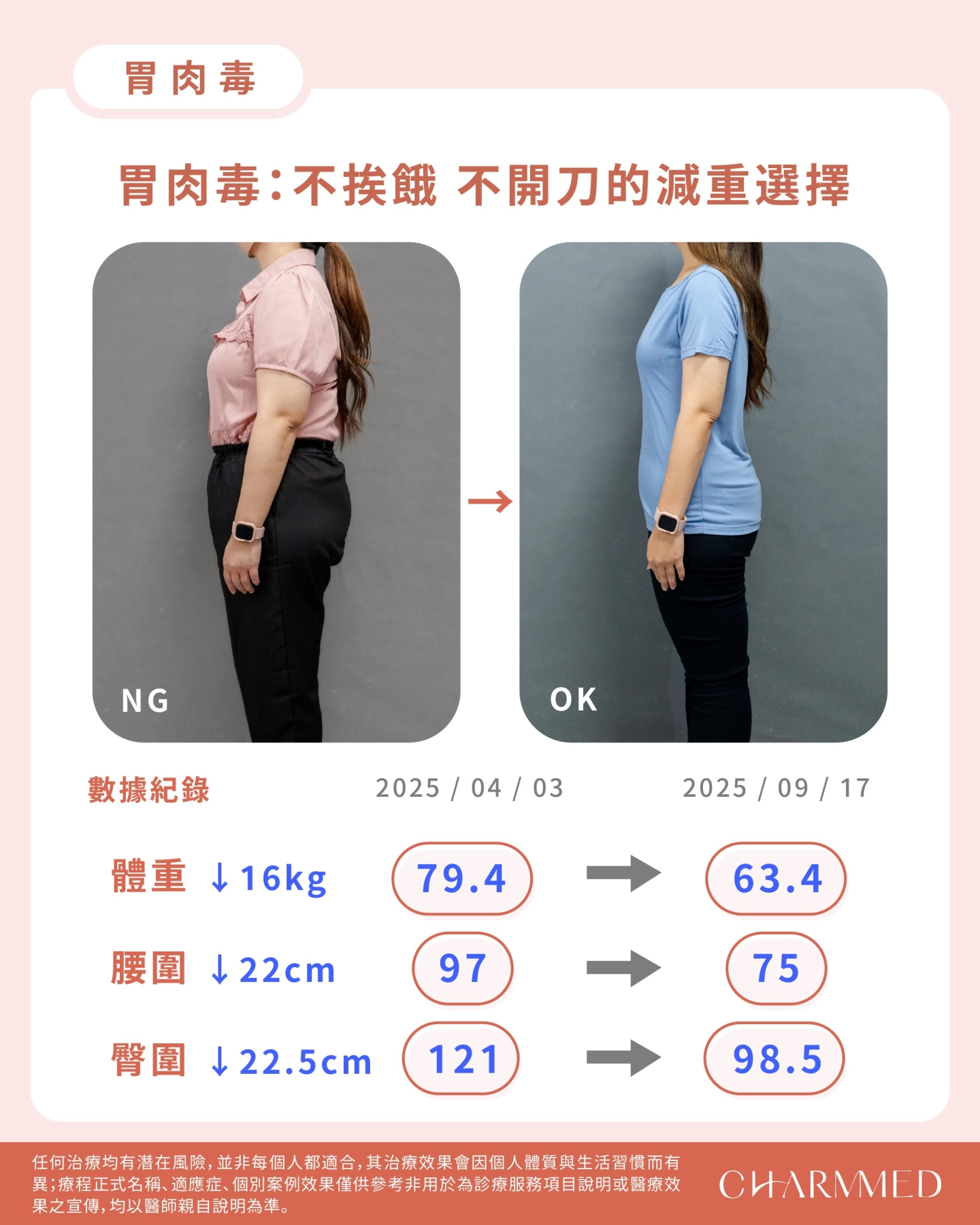 誠美學診所胃肉毒減重成果數據