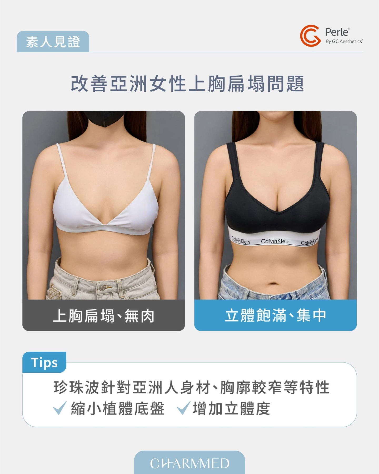 自體脂肪隆乳vs珍珠波,哪一種更適合你?