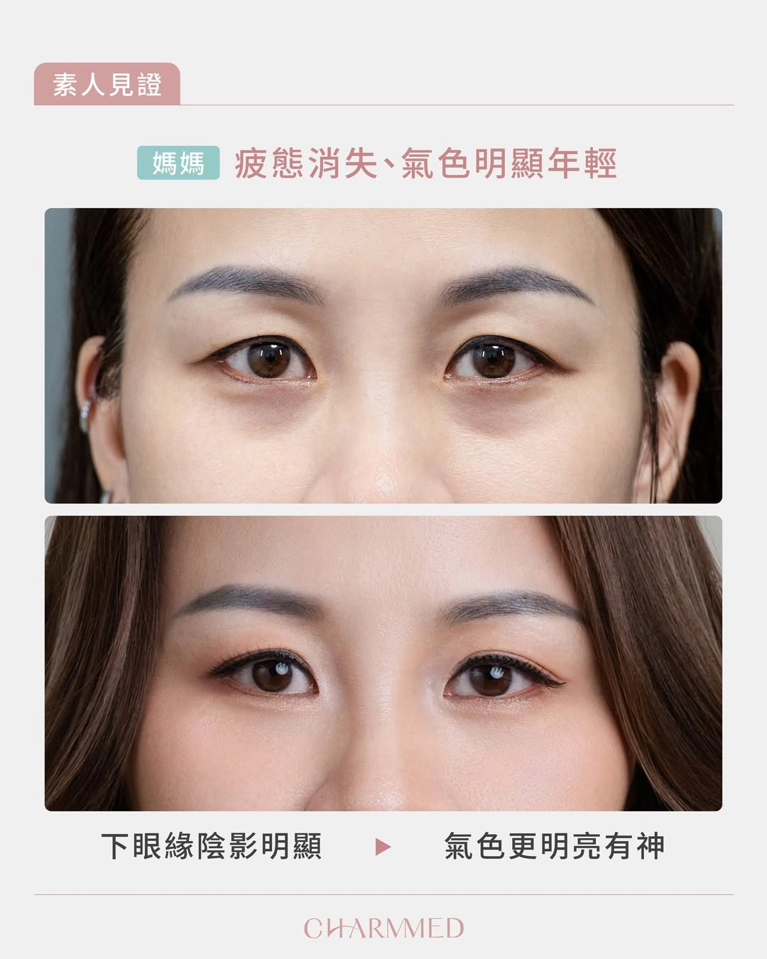 誠美學診所媽媽雙眼皮眼袋手術